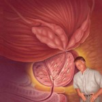 La prostatitis en la fertilidad